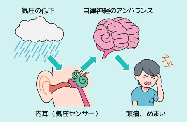 気圧の変化による頭痛
