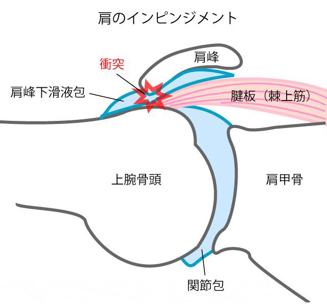 肩のインピンジメント
