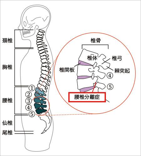 腰椎分離症
